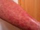 La kératose actinique - une maladie précancereux de la peau